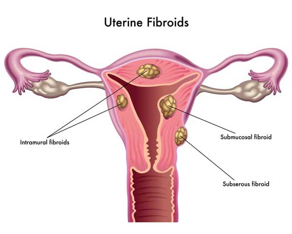 Fibroids