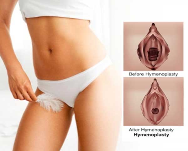 Hymenoplasty