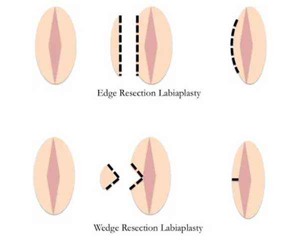 Labiaplasty