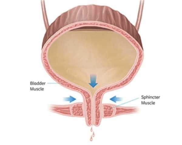 Stress Urinary Incontinence