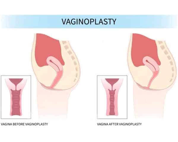 Vaginoplasty